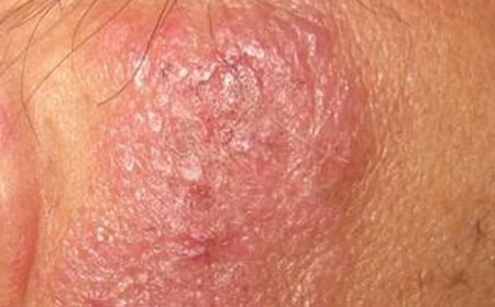 秋季湿疹注意,秋季湿疹发病部位