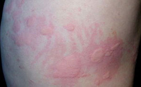 潍坊银康医院,怎样治慢性荨麻疹