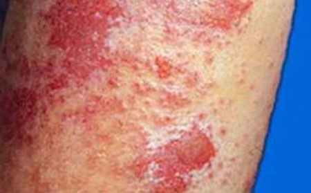 潍坊银康医院,荨麻疹饮食注意