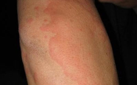 潍坊银康医院,如何治疗和预防荨麻疹