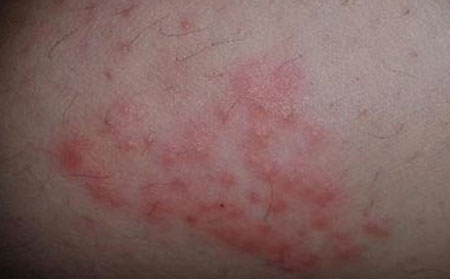 皮肤过敏预防,潍坊银康医院