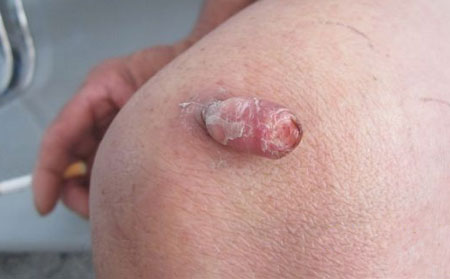 潍坊银康医院,寻常疣怎么去除