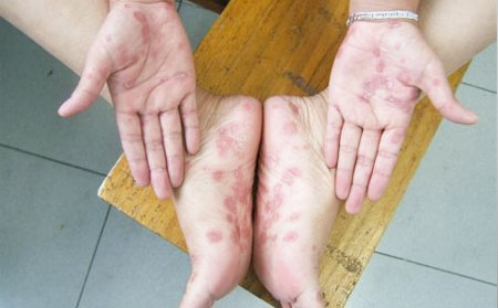 手足癣怎么回事,潍坊银康医院