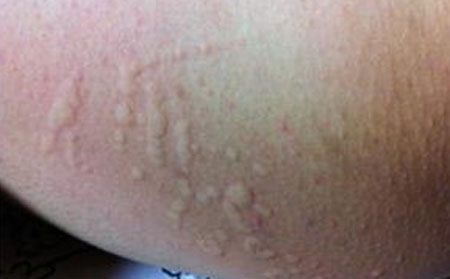 潍坊银康医院,荨麻疹可以怀孕吗