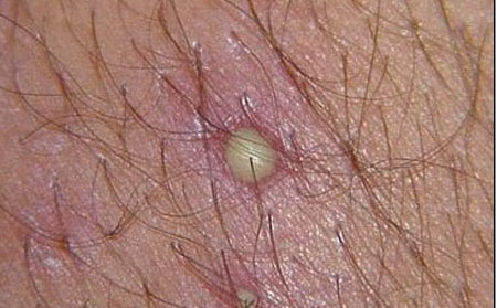 潍坊银康医院,毛囊炎图片