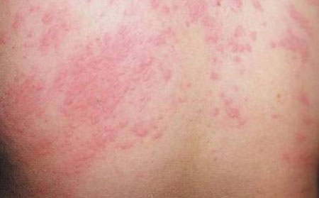 儿童患皮炎原因,儿童皮炎怎么办