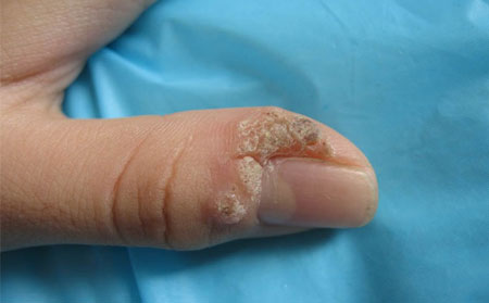 寻常疣常识,寻常疣会自愈吗