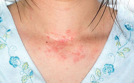 带状疱疹症状-灵敏度