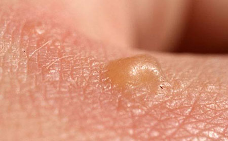 带状疱疹症状-水泡