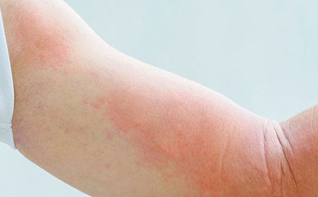 带状疱疹症状-皮疹