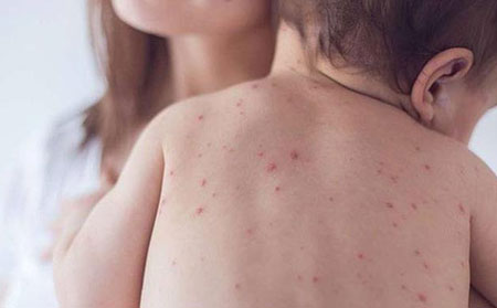 什么是麻疹有什么症状-红色斑点