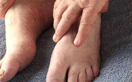 引起皮肤癣的原因-头癣手足癣