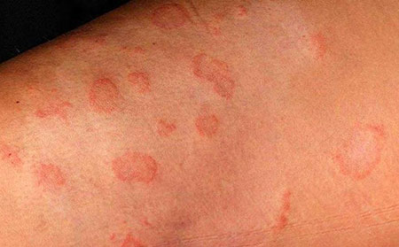 皮肤癣的初期症状是什么