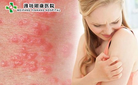 疥疮的常见症状_潍坊市皮肤病医院