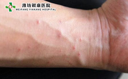 疥疮的罕见迹象_潍坊市皮肤病医院
