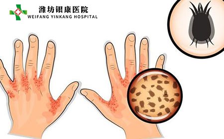 疥疮的原因_潍坊市皮肤病医院