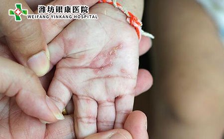 潍坊银康医院_疥疮会传染吗