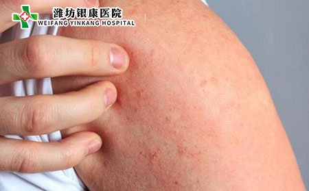 潍坊银康医院_疥疮会持续多久