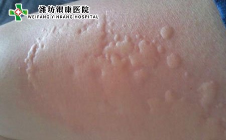 皮肤过敏,夏季皮肤过敏的症状,潍坊市皮肤病医院