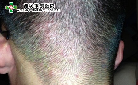 毛囊炎的危害都有哪些?治疗皮肤病潍坊银康专科