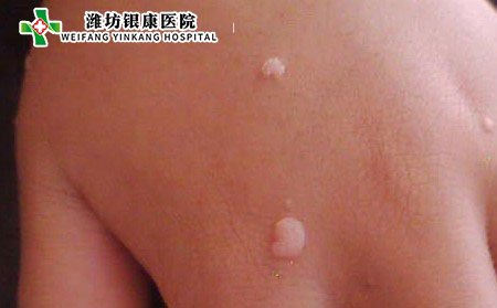 扁平疣病人的护理禁忌有哪些?治疗皮肤病潍坊银康专科