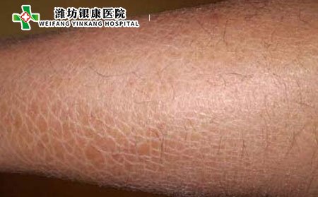 女性鱼鳞病病因,女性为什么得鱼鳞病
