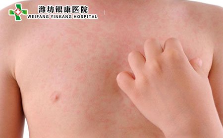 过敏性紫癜最初可能表现为小荨麻疹。