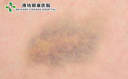 老年人更容易出现瘀伤。