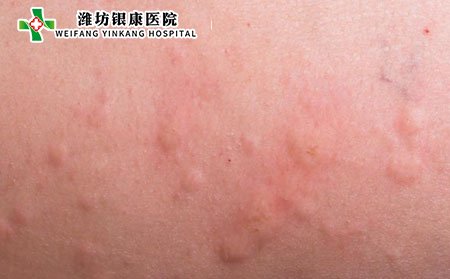 过敏性紫癜可能需要四到六周才能消退。