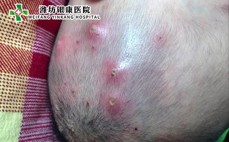 毛囊炎的症状图片