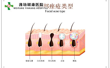 什么是痤疮传染吗