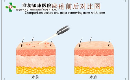 潍坊银康皮肤科医生如何治疗痤疮