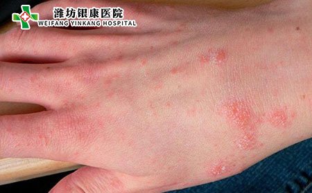 潍坊市皮肤病银康医院介绍导致毛囊炎的原因有哪些?