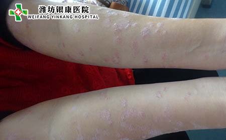 儿童银屑病症状,儿童银屑病症状图片