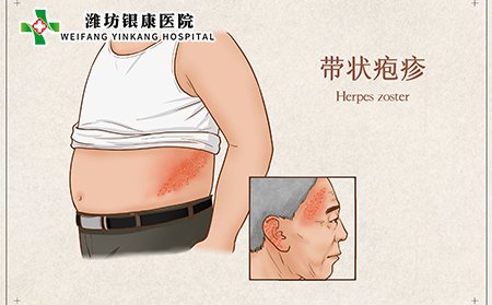 水痘—带状疱疹病毒(VZV)疱疹症状图片