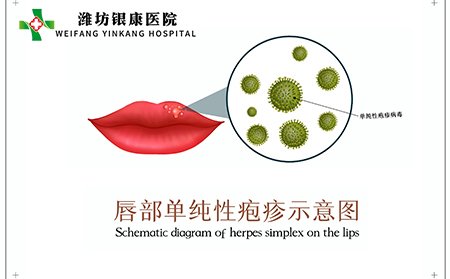 单纯疱疹病毒(HSV)疱疹症状图片