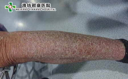 儿童银屑病,儿童银屑病严重怎么办