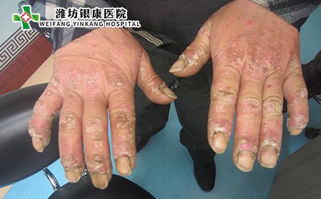 掌跖脓疱病的症状图片