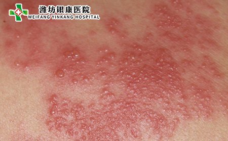 皮炎湿疹的图片症状