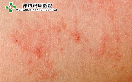 接触性皮炎图片症状