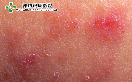 湿疹性皮炎图片症状