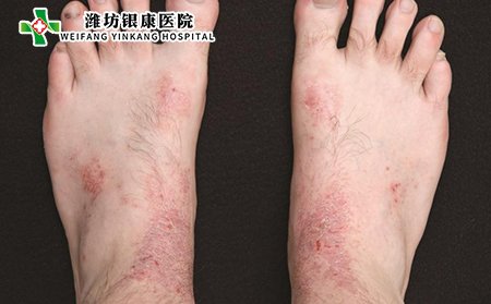 继发性皮炎图片症状