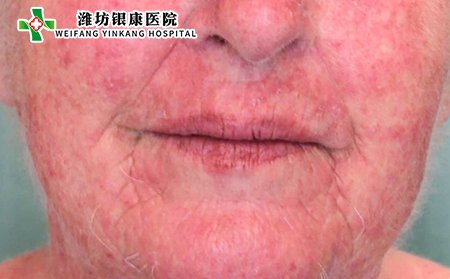 刺激性皮炎图片症状