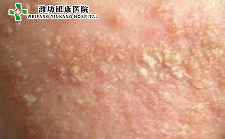 男性皮肤瘙痒原因,男性为什么皮肤瘙痒