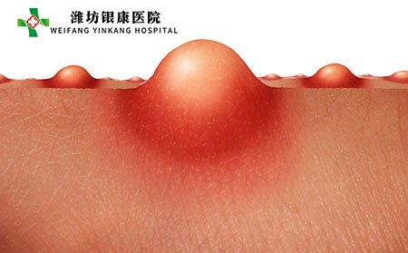 脓疱图片,脓疱症状