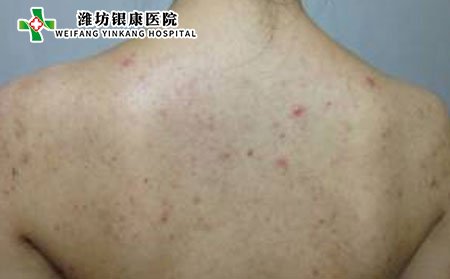 背上长痘痘图片,背上长痘痘症状,痤疮症状图片
