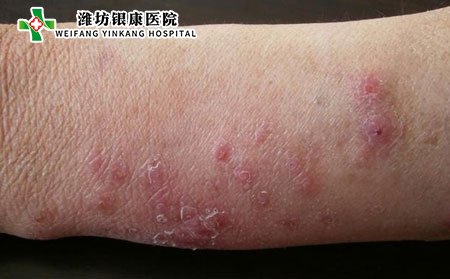 体癣图片类别及症状照片