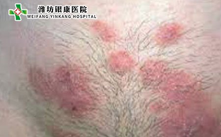 股癣图片类别及症状照片
