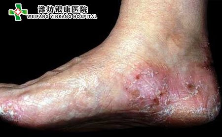脚癣图片类别及症状照片
