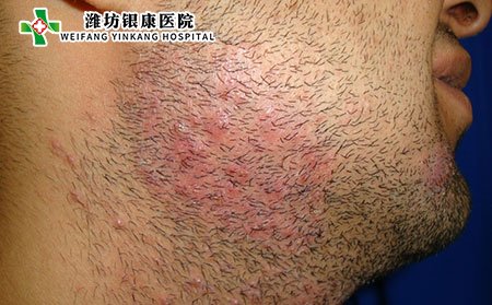 胡须癣图片类别及症状照片